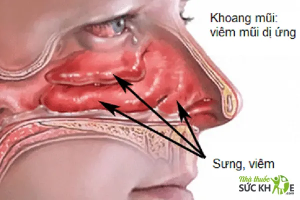 Khoang mũi v&agrave; mũi bị sưng, vi&ecirc;m